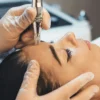 Gros plan d'un soin de microneedling professionnel réalisé sur le visage d'une femme en clinique